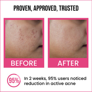 2% Salicylic Acid Active Acne Face Serum