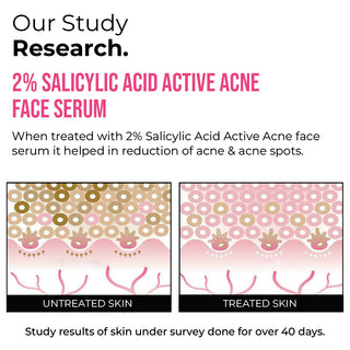 2% Salicylic Acid Active Acne Face Serum